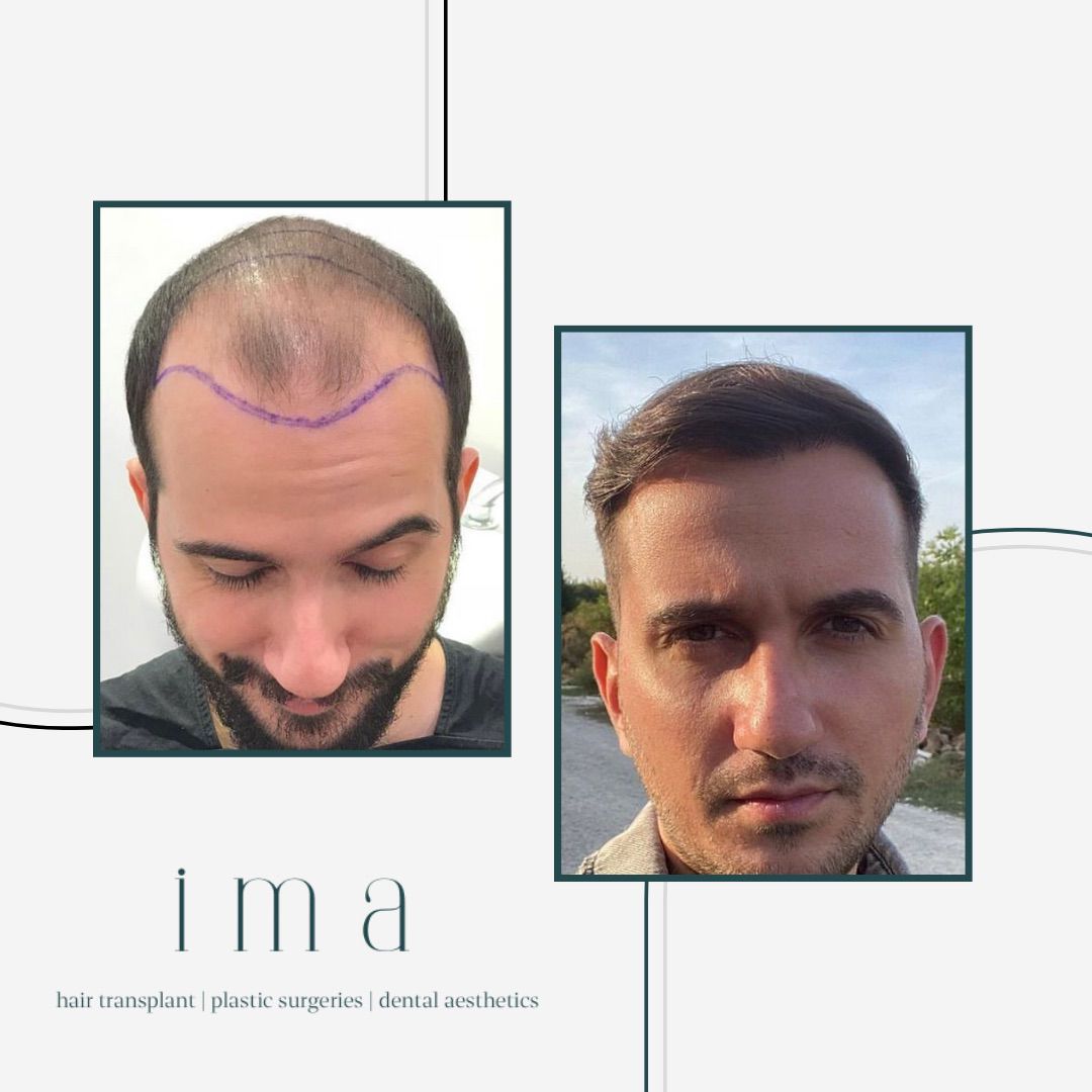 Saç Ekimi 3. Ay Sonuçları: Ne Beklemeli?