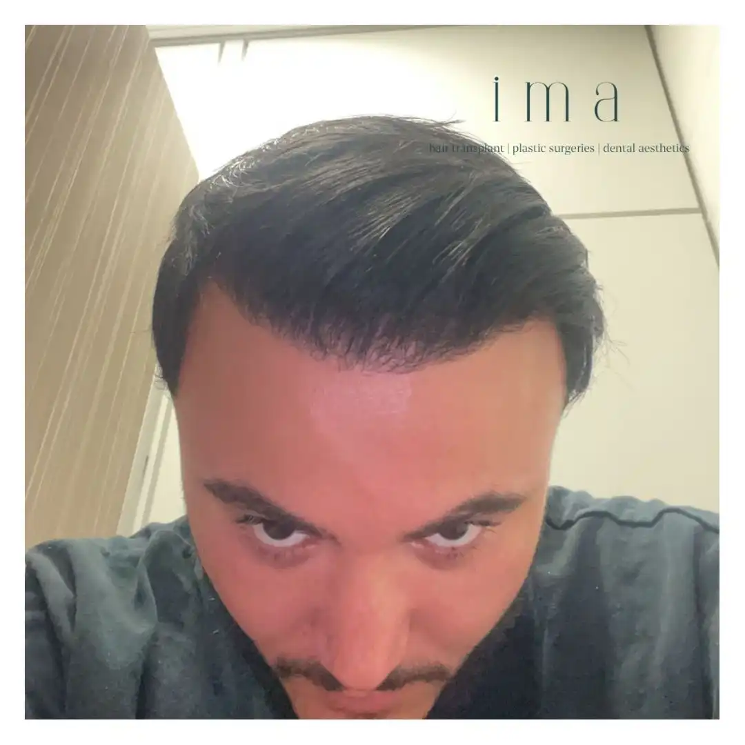 Saç Ekimi 6. Ay Süreci: Detaylı Rehber