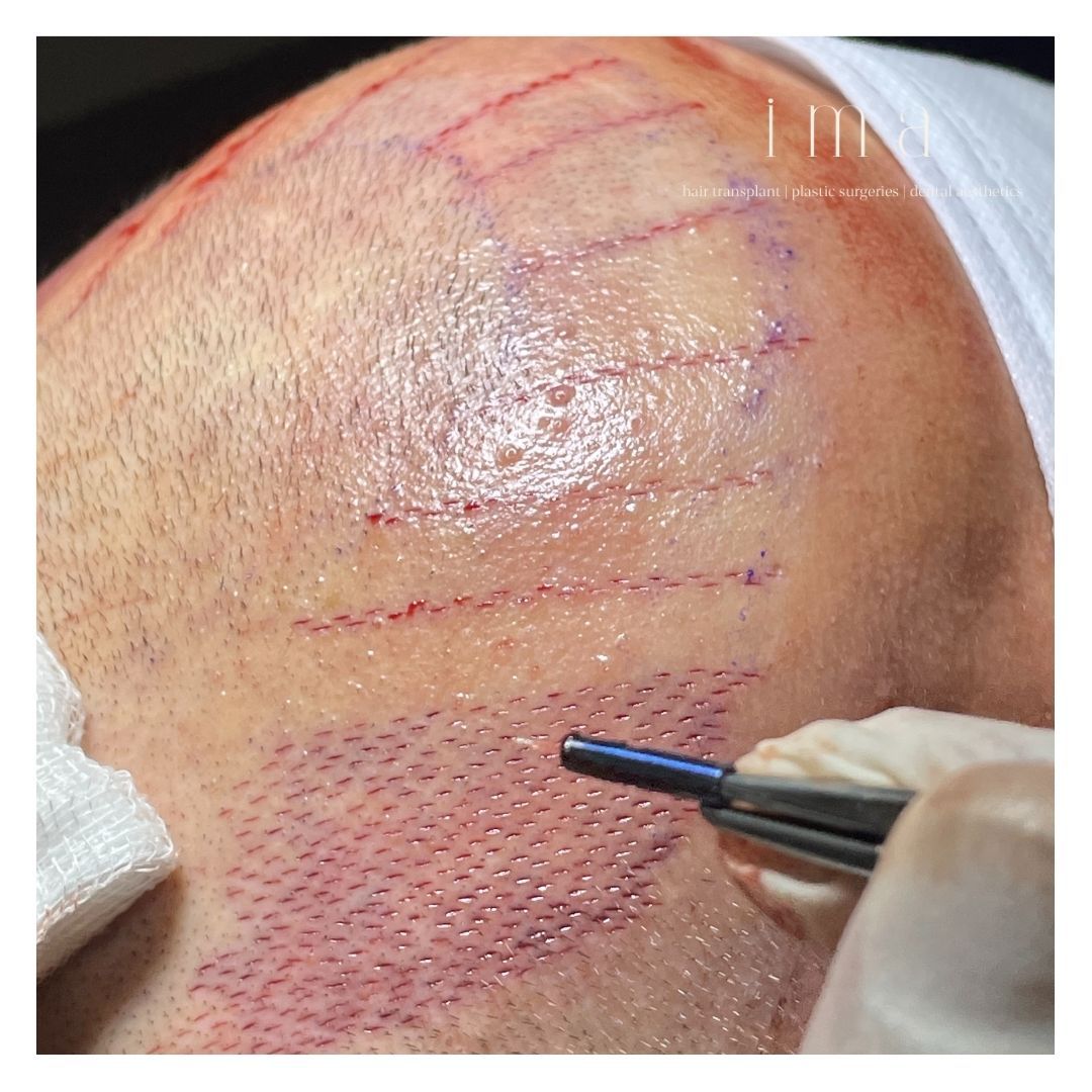 Saç Ekimi Fiyatları 2025: Detaylı Fiyat Rehberi