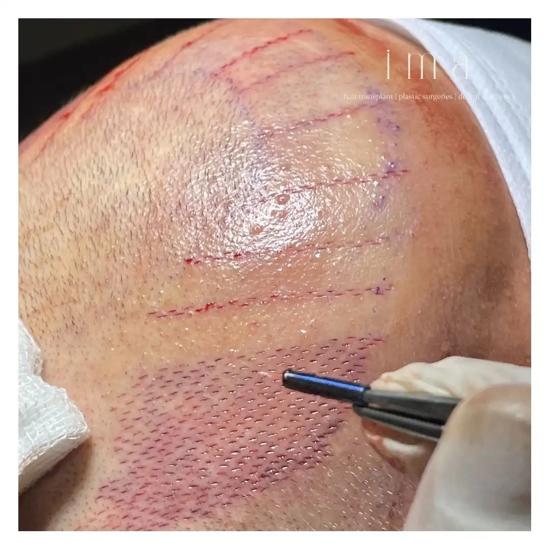 Saç Ekimi Fiyatları 2025: Detaylı Fiyat Rehberi