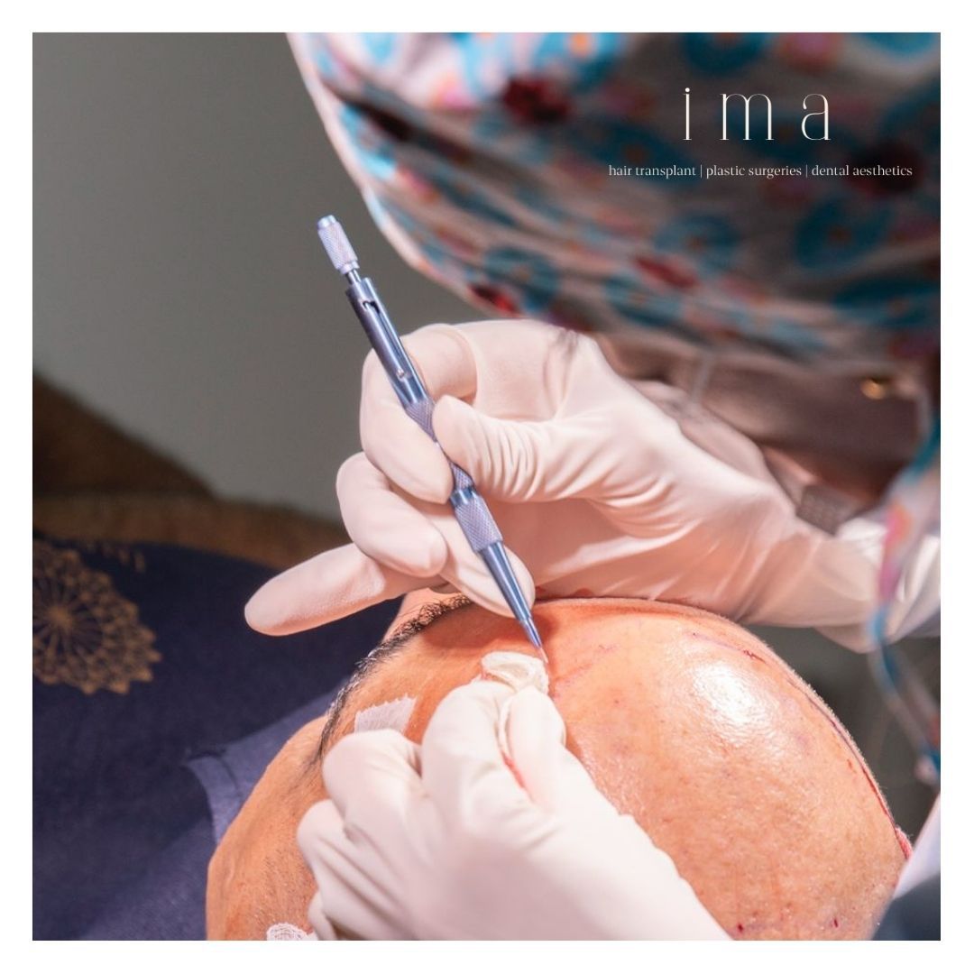 FUE mi DHI mi Daha İyi? Detaylı Karşılaştırma