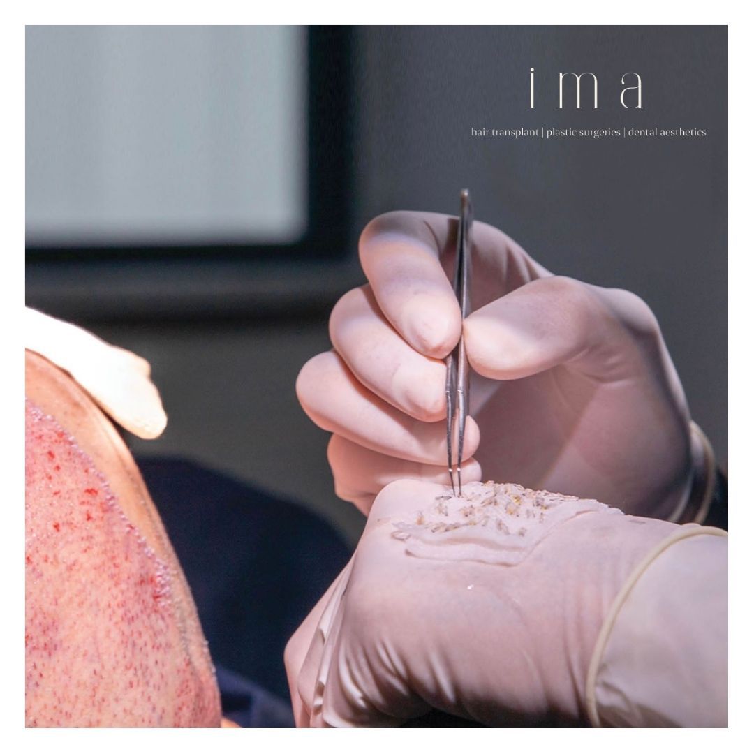 Saç Ekimi Sonrası Kabuklanma Ne Zaman Geçer?