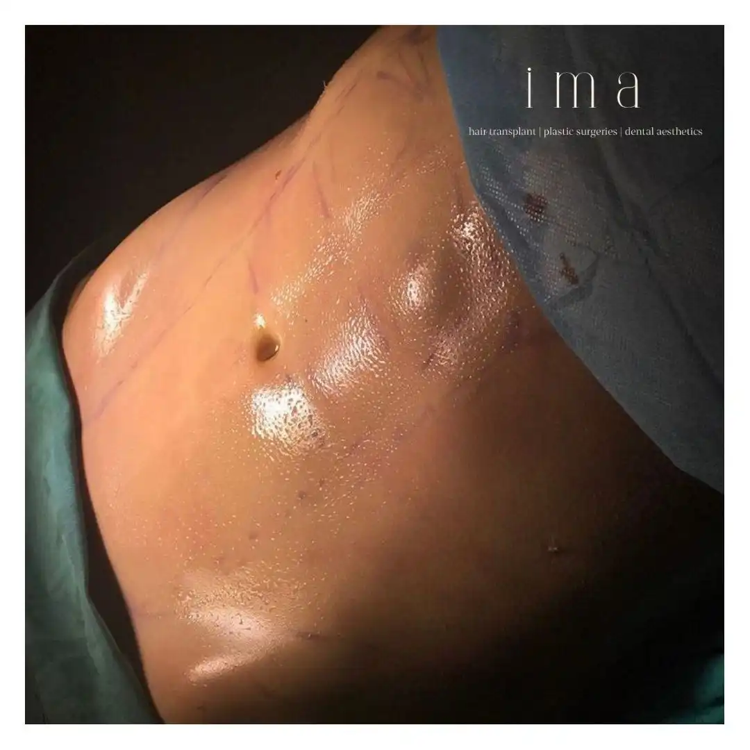 Saç Ekimi Sonrası Kızarıklık Ne Kadar Sürer?